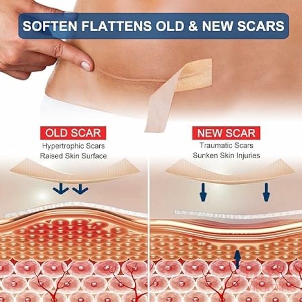 ⁦Silicone Scar Sheets (1.6” x 120” Roll-3M), Silicone Scar Tape Roll, Scar Silicone Strips, Reusable, Professional Scar Removal Sheets for C-Section, Surgery, Burn, Keloid, Acne et⁩ - الصورة ⁦7⁩