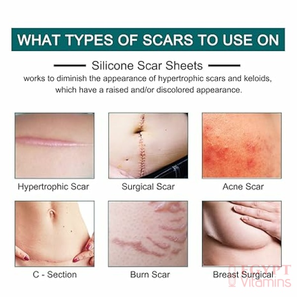 ⁦Silicone Scar Sheets (1.6” x 120” Roll-3M), Silicone Scar Tape Roll, Scar Silicone Strips, Reusable, Professional Scar Removal Sheets for C-Section, Surgery, Burn, Keloid, Acne et⁩ - الصورة ⁦3⁩