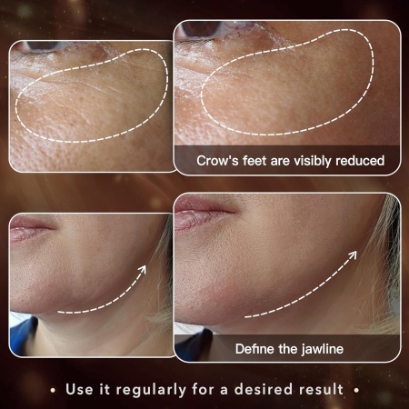 Radio Frequency Skin Tightening Machine, Results