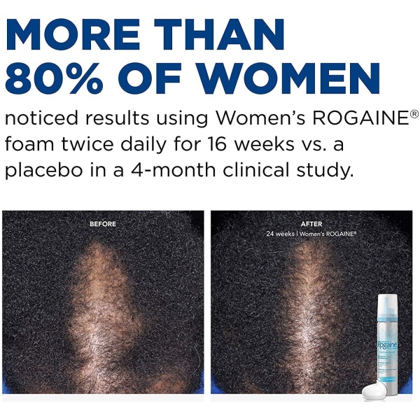 Rogaine 5_ Minoxidil Foam for Women 2-Month Supply Before & After